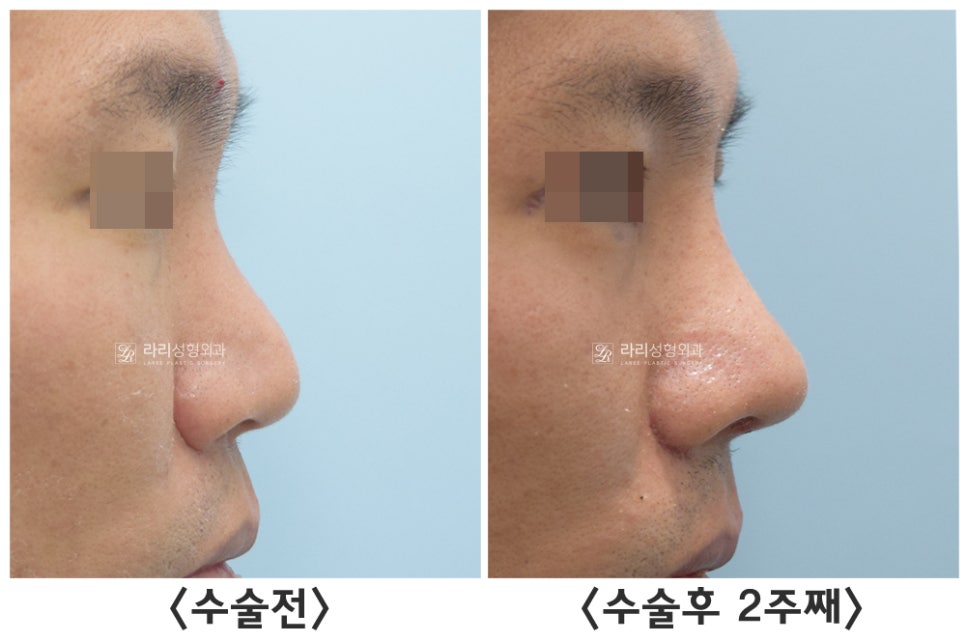 [라리성형외과] 자가늑연골을 이용한 여러 가지 코 수술 : 고난이도 코성형의 핵심 재료 관련 이미지 6