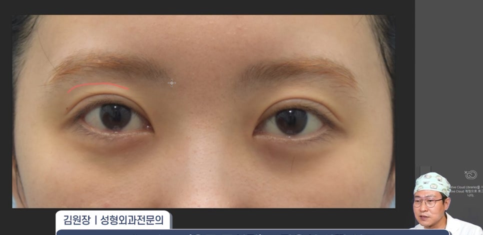 [라리성형외과] 쌍꺼풀재수술 라인 낮추는 두 가지 수술법 (절제방법 , 두줄따기방법) 관련 이미지 12