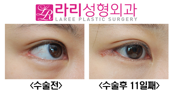 [라리성형외과] 다양한 뒤트임복원수술 전후사진 관련 이미지 5