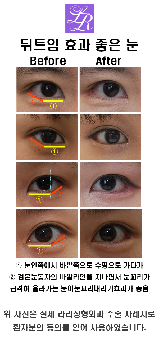 Lateral Canthoplasty Surgery - Recovery, Before and After, Good Results for the Eyes @Lari Plastic Surgery image 5