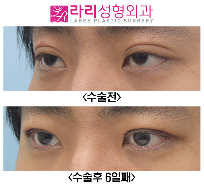 [라리성형외과] 남자 졸려보이는눈 눈매교정 수술 전후 관련 이미지 2