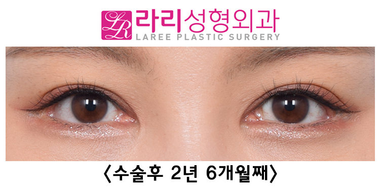 [라리성형외과] 여러 번 반복하지 않아도 되는 두꺼운 아이라인 문신 축소수술 전후 비교 관련 이미지 5
