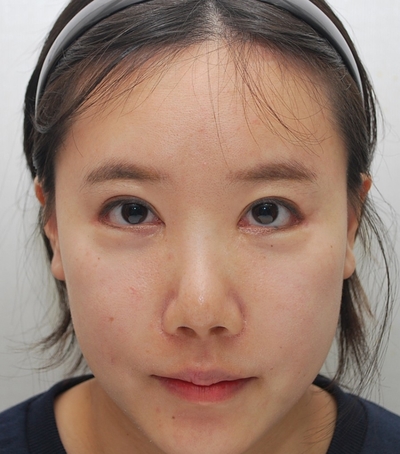 눈꼬리내리기, 뒤트임재수술, 눈밑지방재배치          얼굴인식 바꾸기 관련 이미지 2