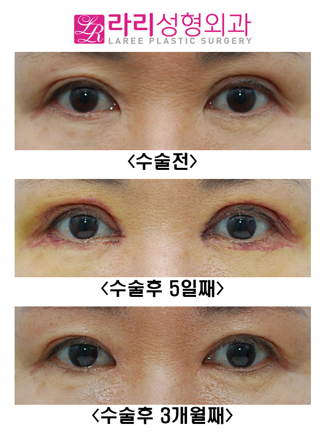 [라리성형외과] 두꺼운 소세지눈 교정 관련 이미지 1