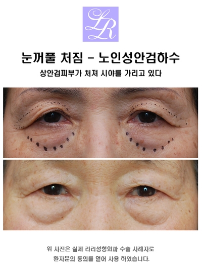 안검하수 눈매교정술 해야하는 경우 관련 이미지 2