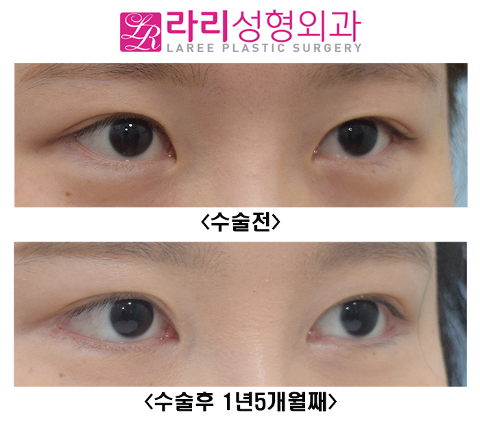 [라리성형외과] 눈이 확실히 커지는 눈 성형수술 3종 세트 (쌍수, 앞트임, 뒤트임) 관련 이미지 2