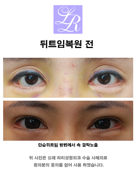 눈 뒤트임복원 (feat. 재건시기, 비용스포)고려하고 있다면 꼭 확인해야 할 포스팅! 관련 이미지 4