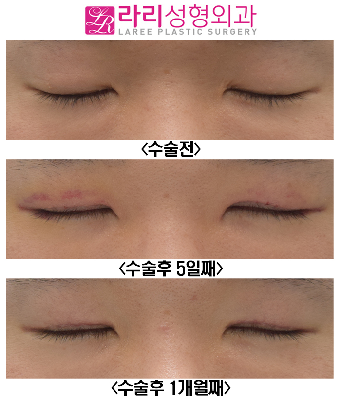 [Rari Plastic Surgery] Recovery Progress After Male Incisional Eye Opening Correction and Double-Eyelid-Free Eye Opening Correction Surgery: Natural and Neat image 3