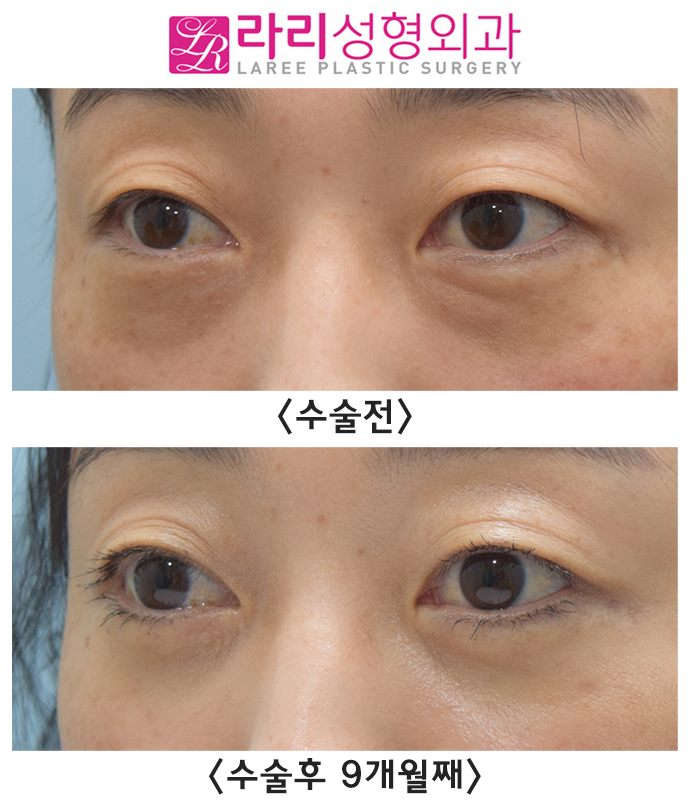 [Lari Plastic Surgery] Lower Blepharoplasty? Under-Eye Fat Repositioning Surgery? Which Surgery Do I Need? image 3