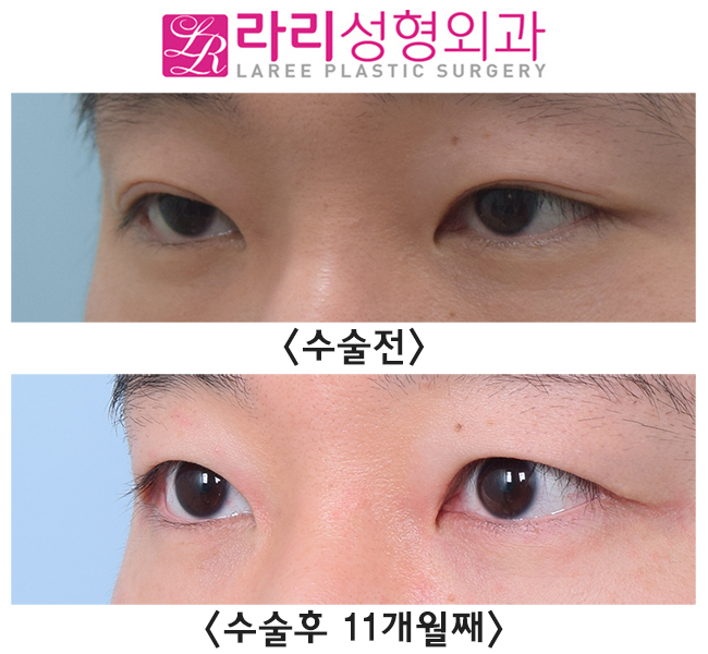 [Lari Plastic Surgery] Triple Set: Asymmetric Eye Correction + Ptosis Correction + Removing Double Eyelids! image 2