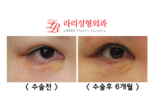 Complications of Lower Blepharoplasty: Ectropion Correction (Senile, Traumatic, Iatrogenic) image 4