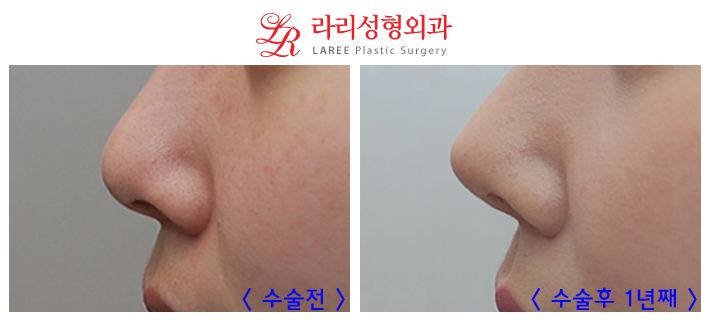 코재수술 잘하는곳 변화가 확실한 라리성형외과! 관련 이미지 2