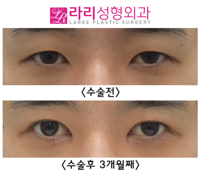 [라리성형외과] 붓기 최소화하는 자연스러운 속쌍꺼풀 남자 절개눈매교정 앞트임수술 전후사진 관련 이미지 2