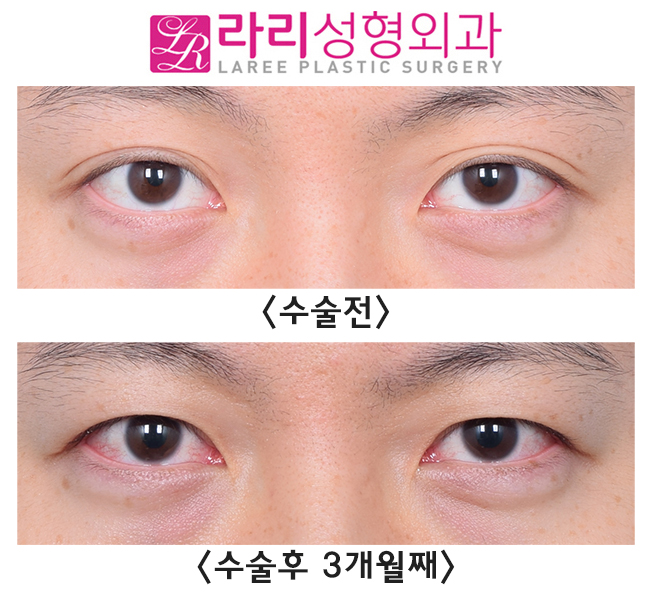 [Rari Plastic Surgery] Recovery Process for Line Irregularity During the Course of Double Eyelid Removal Surgery image 1