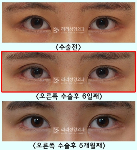 [Lari Plastic Surgery] One-sided double eyelid surgery to correct uneven eyes: Is it possible to get double eyelids on only one eye? image 6