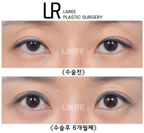 [Lari Plastic Surgery] The Real Way to Make Eyes Bigger: Eyelid Correction Surgery Is Needed Before Canthoplasty. image 1