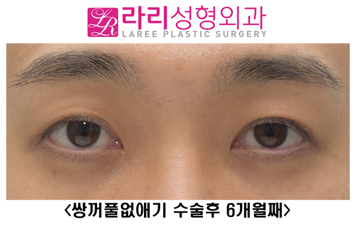 [Lari Plastic Surgery] Should You Get Forehead Botox Before Eye Surgery? image 1