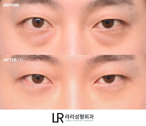 [라리성형외과] 하루(1DAY) 투자로 예뻐지는 라리성형외과의 퀵 눈밑지방재배치수술 관련 이미지 8