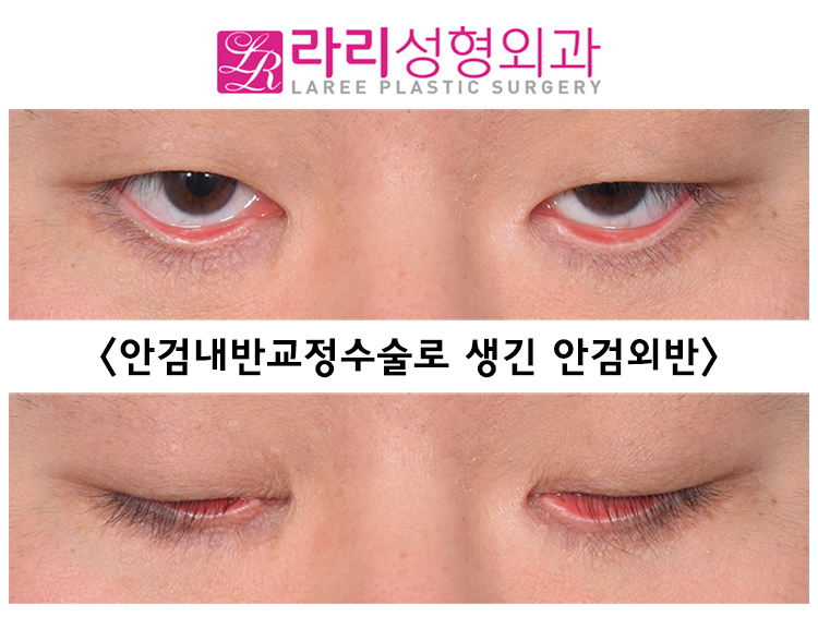 [Lari Plastic Surgery] Lower blepharoplasty including entropion correction, the most common cause of iatrogenic ectropion image 5