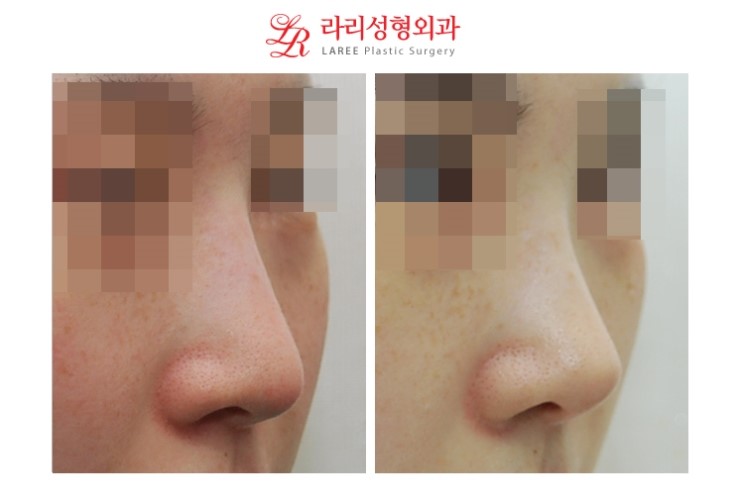 Revision Rhinoplasty for a Drooping Nose & Revision Surgery for a Drooping Nasal Tip
Long Nose & Long Nasal Tip Revision Surgery Before-and-After Photos image 3