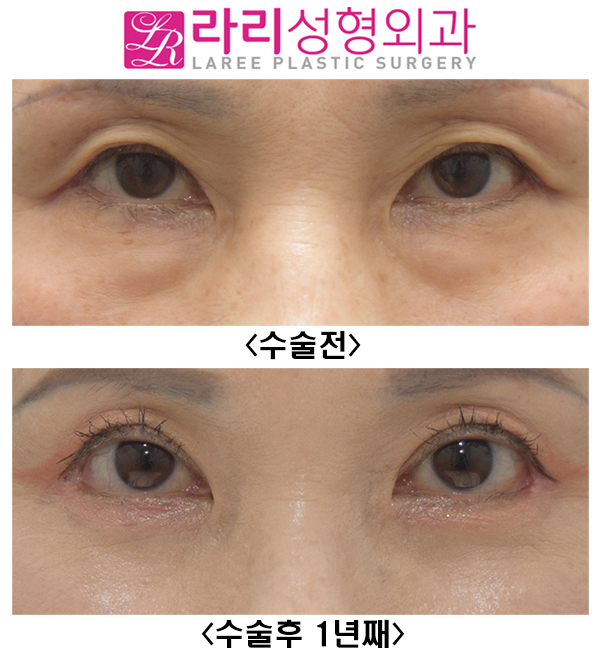 [Lari Plastic Surgery] Upper eyelid surgery, non-epicanthic inner corner surgery, revision outer corner surgery, and lower eyelid fat repositioning can all be done at once. Recovery with good results is possible! image 1