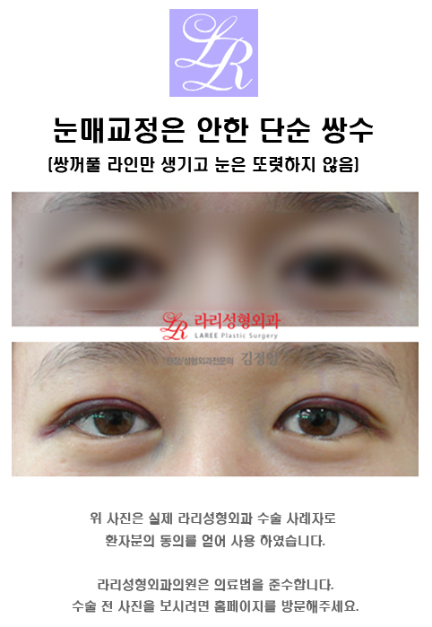 Comparing Swelling After Incisional Ptosis Correction vs. Incisional Double Eyelid Surgery image 1