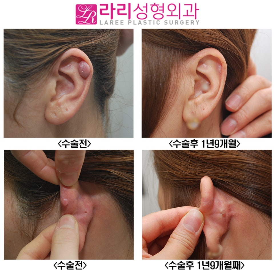 [라리성형외과] 피어싱 켈로이드 주사? 절제수술? 올바른 대처 방법 관련 이미지 1