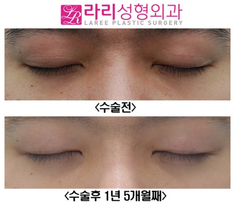 [Lari Plastic Surgery] Removing a Thick Natural Double Eyelid on Men image 4