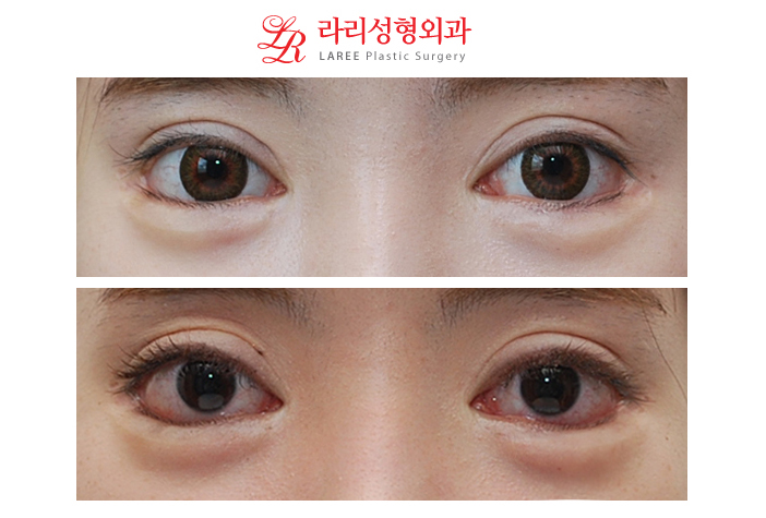 왕눈이성형 바비밑트임 재수술 전후사진-♩ 관련 이미지 1