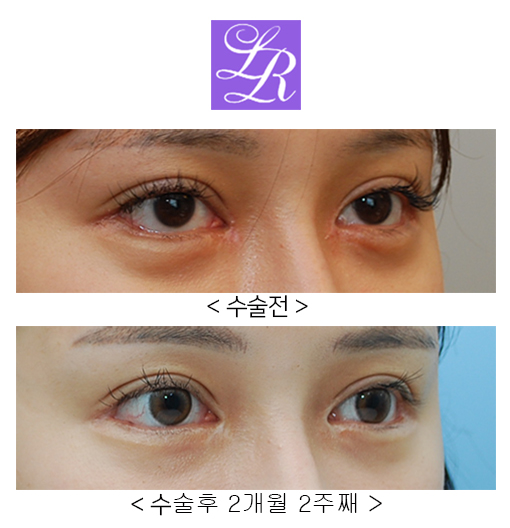 비절개눈매교정,눈꼬리내리기뒤트임 (졸린눈, 화난눈 교정) 관련 이미지 4