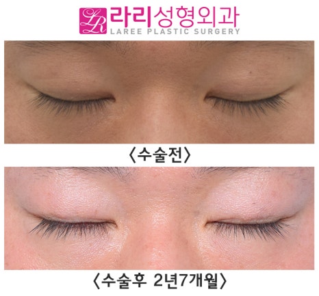 [라리성형외과] 자연쌍꺼풀없애기 2년 이상 장기 경과 전후 사진 관련 이미지 2