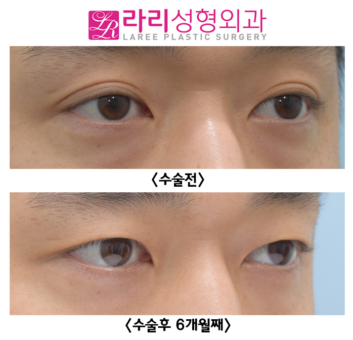 [라리성형외과] 두꺼운 자연 쌍꺼풀 완전 무쌍으로 만드는 쌍꺼풀제거수술 전후사진 관련 이미지 4