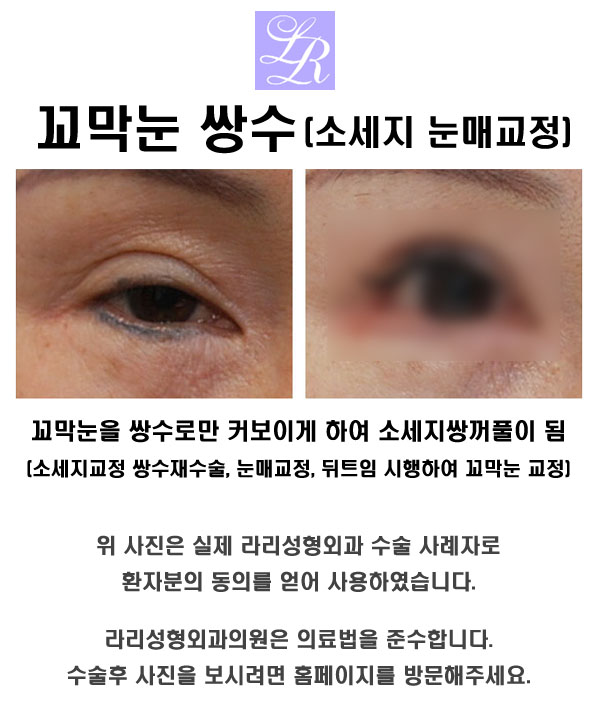 눈 가로길이, 트임 정말 길어질까 관련 이미지 1