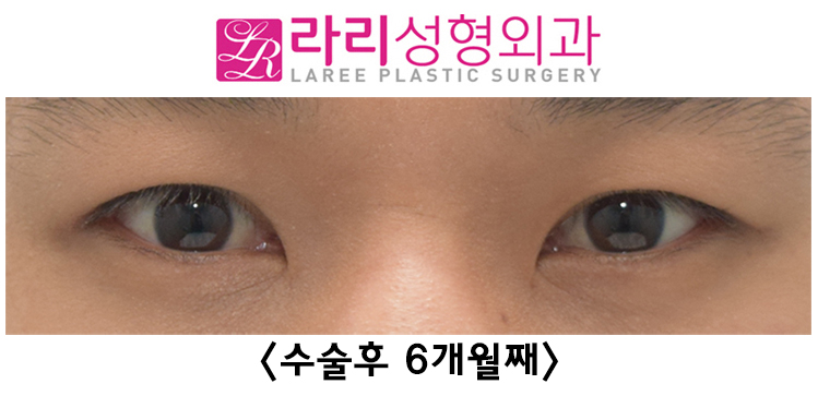[Lari Plastic Surgery] See the Process of Correcting Uneven Eyes After Double Eyelid Removal Surgery image 4