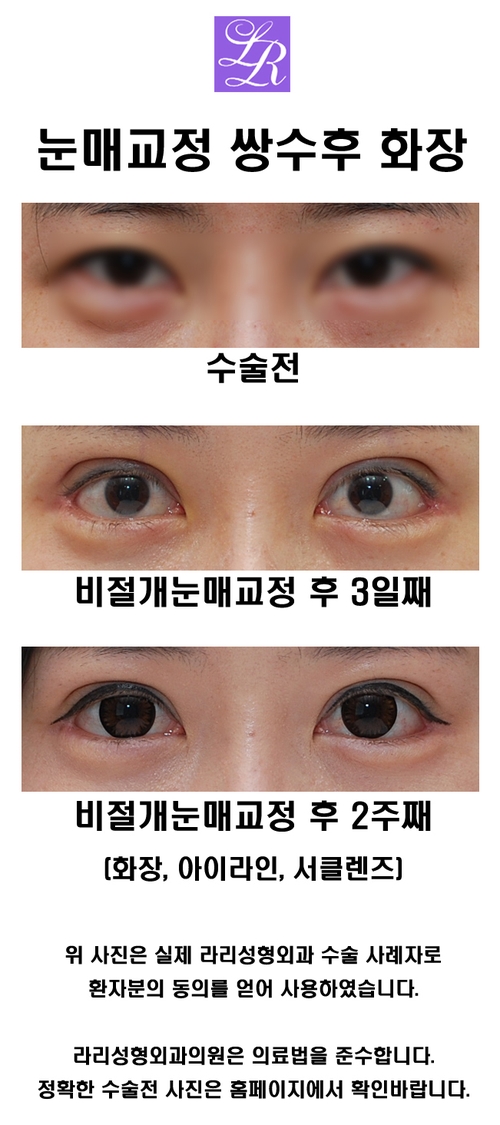 Double Eyelid Surgery, Eye Plastic Surgery: Questions About Washing Hair and Eye Makeup image 2