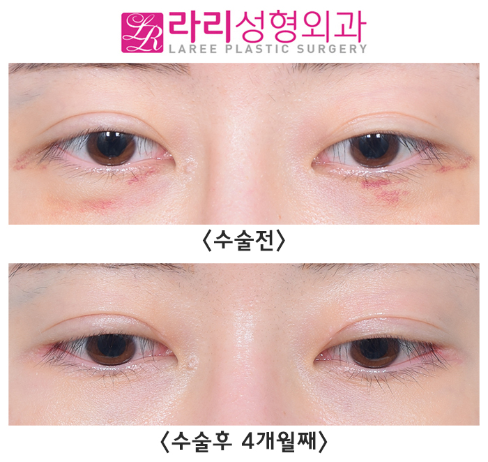 [Lari Plastic Surgery] Revision Double Eyelid Surgery: Micro Line Reduction, Micro Outer Corner Adjustment - Natural as if Nothing Was Done image 2