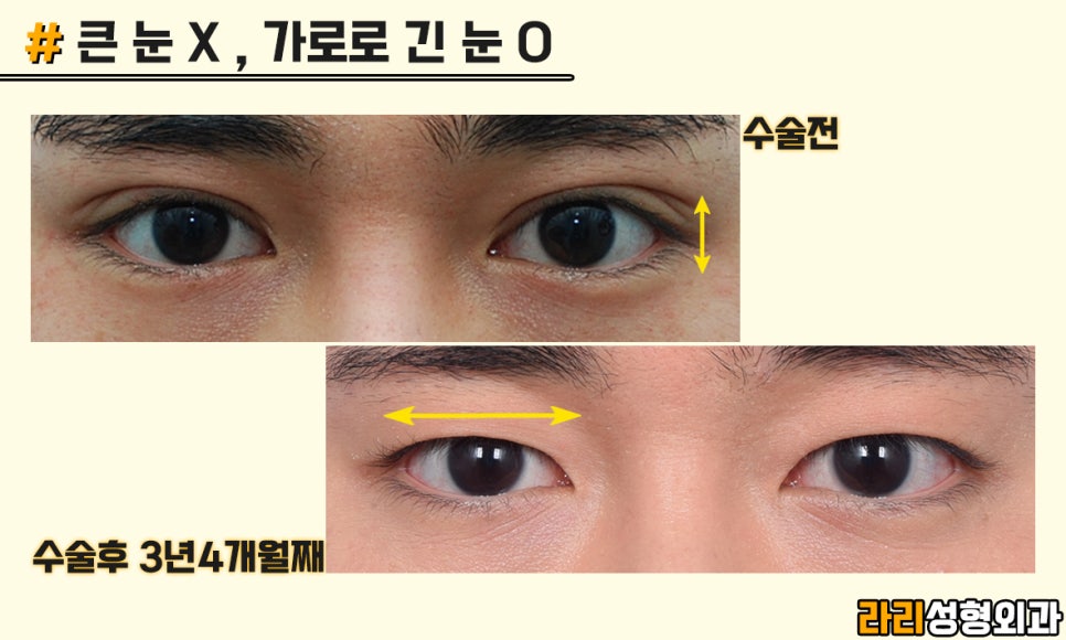 [Lari Plastic Surgery] Men’s Eye Surgery, Trends and Desired Look - Monolid & Hidden Double Eyelid image 7