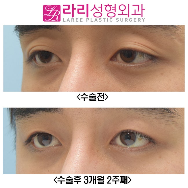 [라리성형외과] 쌍꺼풀 없애는 수술 받으면 쌍꺼풀 없애기 가능한가요..? 관련 이미지 3