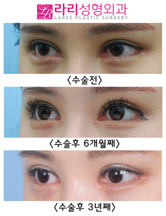 [Laree Plastic Surgery] Before-and-After Photos of Long-Term Follow-Up After Medial Epicanthoplasty Revision, Following Short-Term Follow-Up image 1