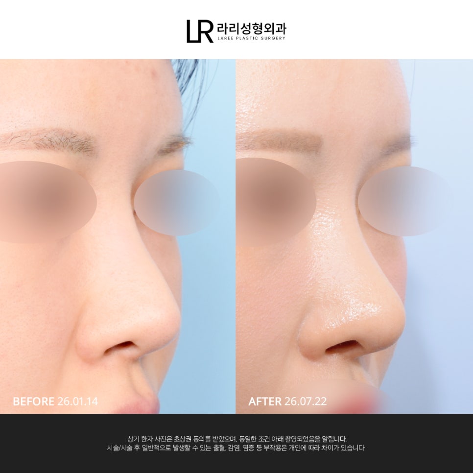 [LARI Plastic Surgery] Structural Line Rhinoplasty Revision Connecting the Nasal Bridge, Dorsum, and Tip image 1