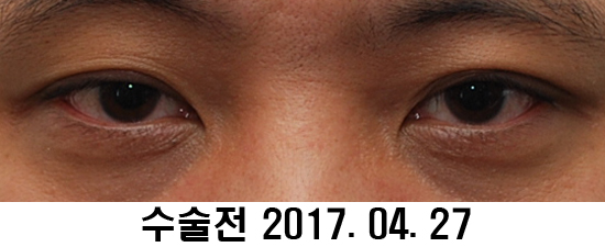Before and After: Sharper Male Eye Correction (feat. Video) image 8