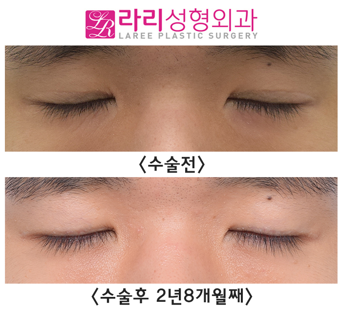 [Lari Plastic Surgery] Removing Eyelid Creases: Eyes Not Closing Fully, Side Effects, Recovery, Before-and-After Photos image 3