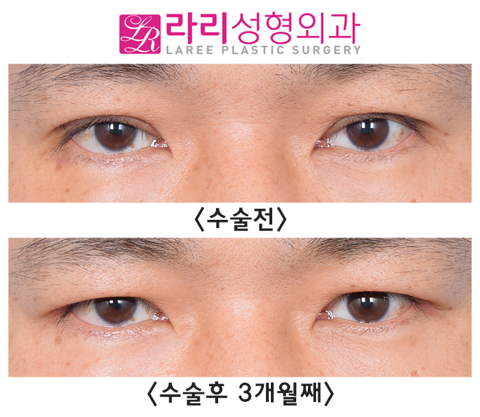 [라리성형외과] 절개 눈매교정 후 급속교정, 6개월 기다리지 않고 일주일 만에 쌍꺼풀없애기 관련 이미지 1