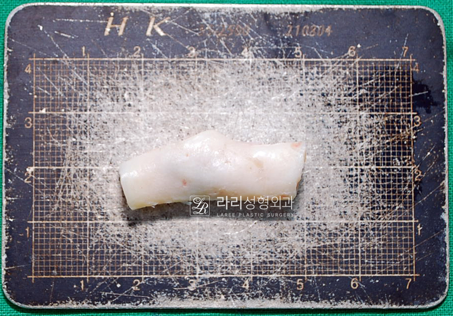 [라리성형외과] 자가늑연골을 이용한 여러 가지 코 수술 : 고난이도 코성형의 핵심 재료 관련 이미지 2
