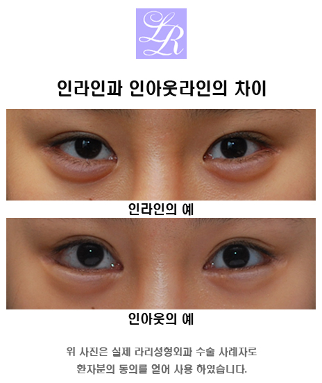 Eye In-Inner, Outer, and Double-Eyelid Line Selection image 3
