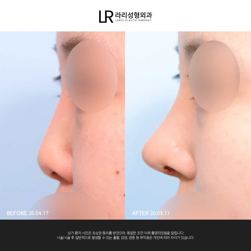 [Lari Plastic Surgery] If You Are Considering Nose Surgery, Do Not Get Nose Thread-Lifting Procedures Like Misko / Hiko!! image 3