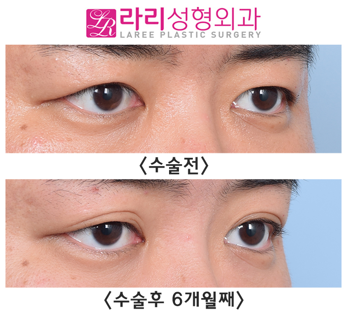 [Rari Plastic Surgery] Difficulty Opening the Eyes, Severe Asymmetry, and Multiple Eyelid Creases: Solved with Crease Removal Surgery! image 3