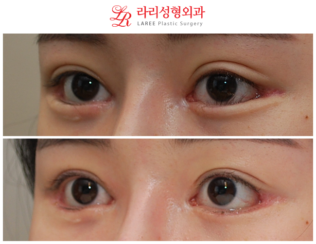 Can Lower-Eyelid Surgery and Entropion Correction Be Done at the Same Time? image 3