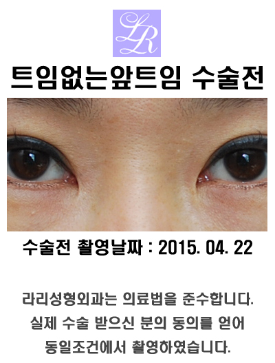 몽고주름제거하는 앞트임 - 갈고리 모양 교정 관련 이미지 6
