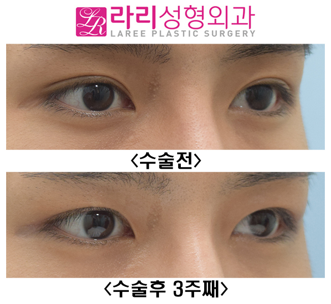 [라리성형외과] 인아웃라인 자연쌍꺼풀을 무쌍속쌍으로 만들기 관련 이미지 2